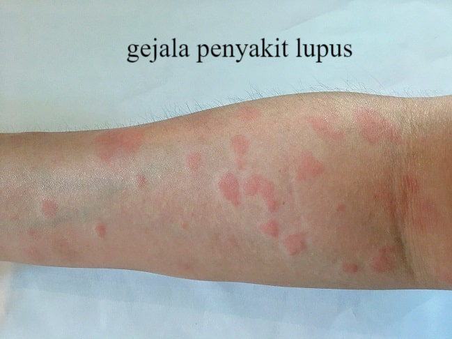 Bakteri Kulit Ternyata Bisa Picu Penyakit Lupus – DEPOK POS